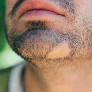 Trous dans la barbe - Huile de ricin