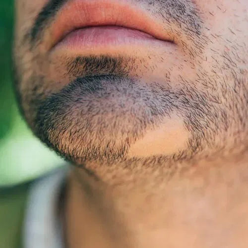 Trous dans la barbe - Huile de ricin